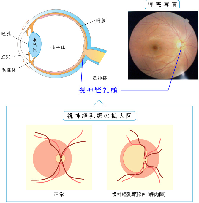 視神経乳頭陥凹、視神経繊維層欠損の図