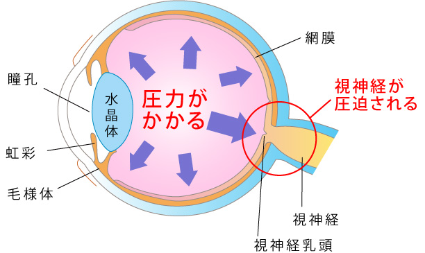 眼圧が高い図