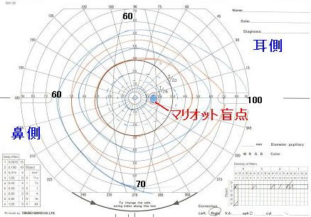 ゴールドマン視野計