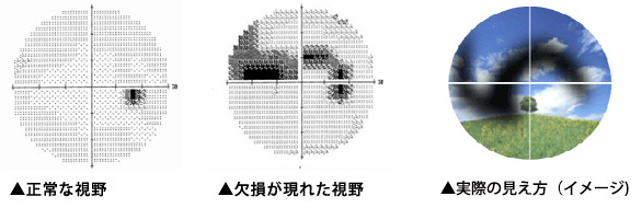 ハンフリー視野計