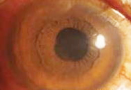 代表的な角膜疾患