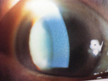 角膜ジストロフィー