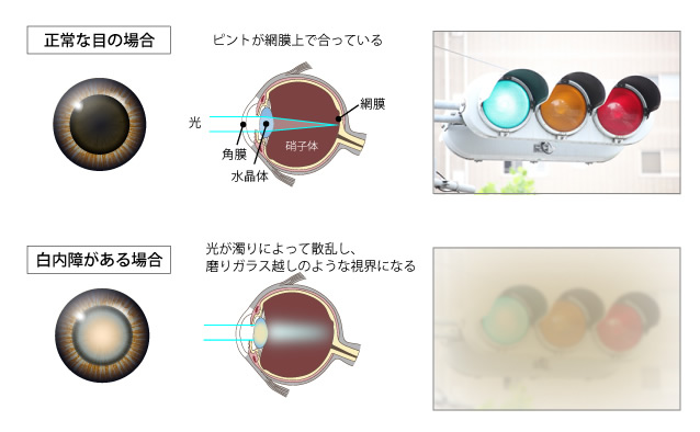 正常な目の場合、ピントが網膜上で合っている。白内障がある場合、磨りガラス越しのような視界になる