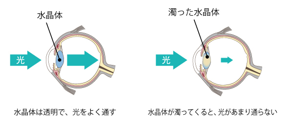 水晶体は透明で、光をよく通す。水晶体が濁ってくると、光があまり通らない