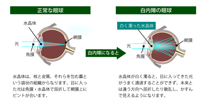 正常な眼球と白内障の眼球。水晶体が白く濁ると、目に入ってきた光がうまく通過せず、本来とは違う方向へ屈折したり散乱し、かすんで見えるようになります。