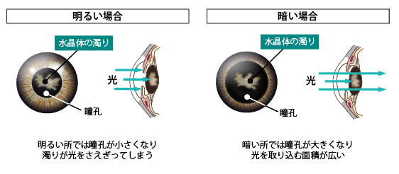 明るい所では瞳孔が小さくなり濁りが光をさえぎってしまう。暗い所では瞳孔が大きくなり、光を取り込む面積が広い。