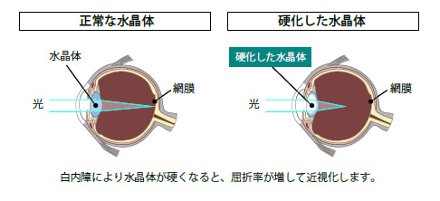 白内障により水晶体が硬くなると、屈折率が増して近視化します