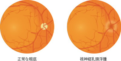 視神経乳頭浮腫