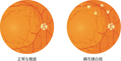 綿花様白斑