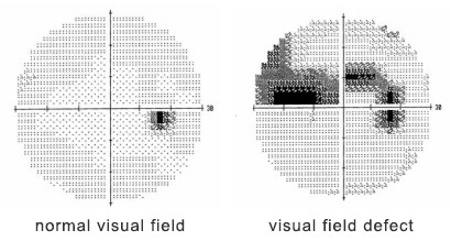 A curtain-like shadow over your visual field