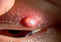 Chalazion