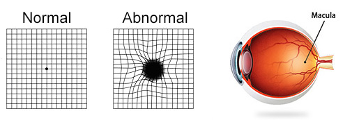 Macular Degeneration