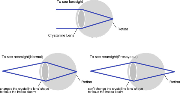 presbyopia