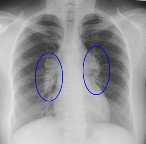 Sarcoidosis