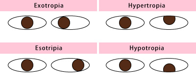 Macular Hole