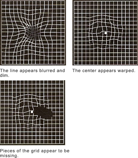 Amsler grid eye test