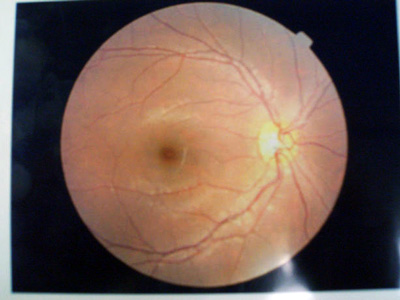 Retinal Examination(Ophthalmoscopy)