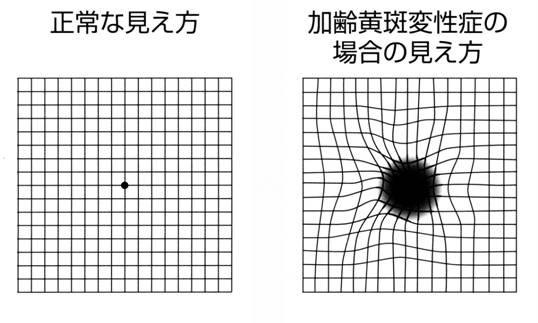 抗VEGF抗体療法/加齢黄斑変性について