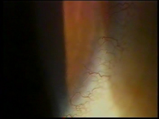 角膜新生血管